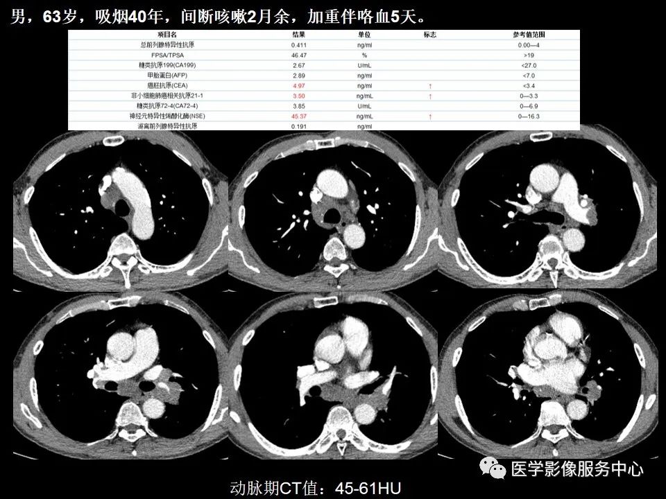 影像PPT - 【病例】中央型小细胞肺癌的CT与病理分析-4