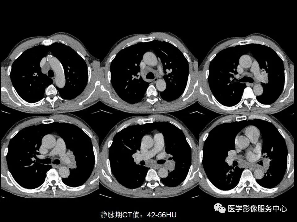 影像PPT - 【病例】中央型小细胞肺癌的CT与病理分析-5