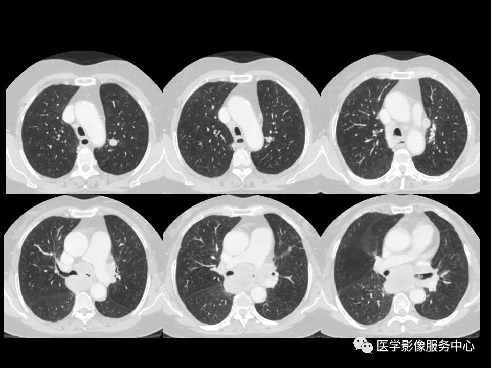 影像PPT - 【病例】中央型小细胞肺癌的CT与病理分析-3