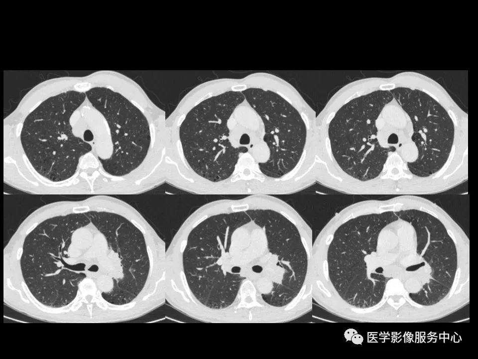 影像PPT - 【病例】中央型小细胞肺癌的CT与病理分析-6
