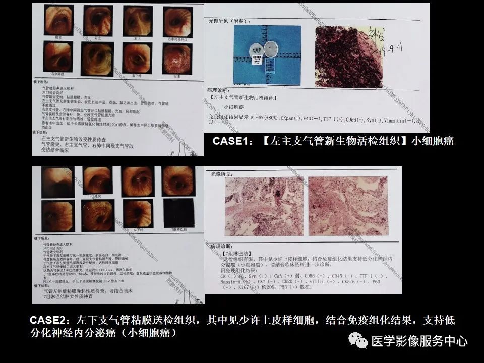 影像PPT - 【病例】中央型小细胞肺癌的CT与病理分析-8