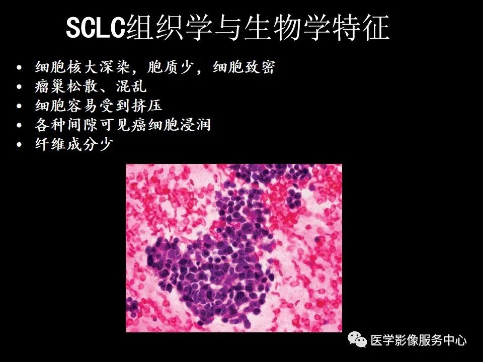 影像PPT - 【病例】中央型小细胞肺癌的CT与病理分析-10