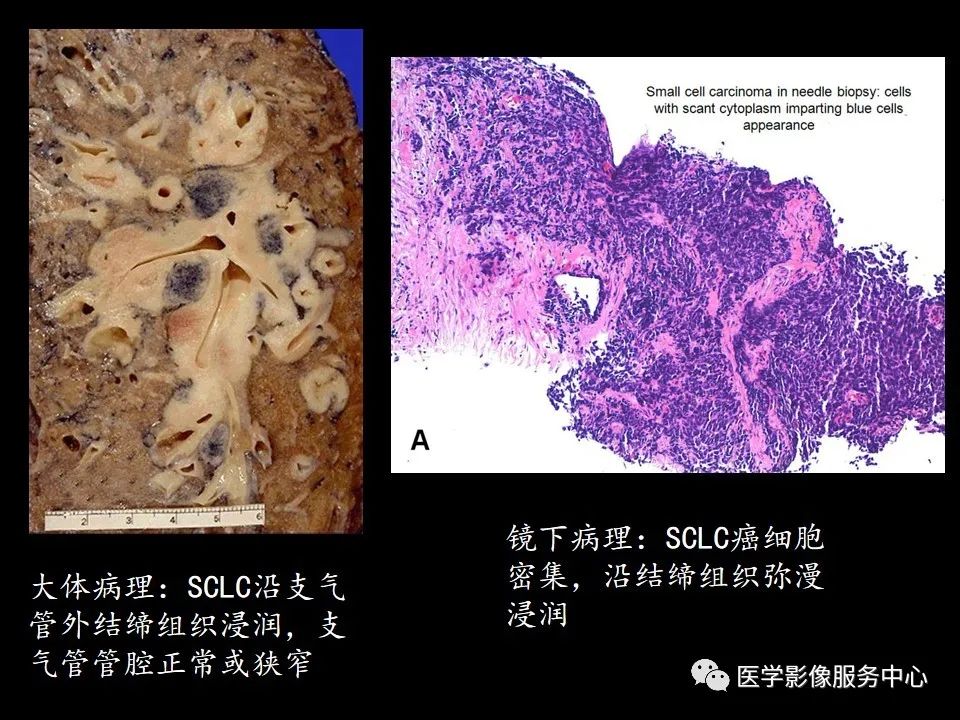 影像PPT - 【病例】中央型小细胞肺癌的CT与病理分析-14