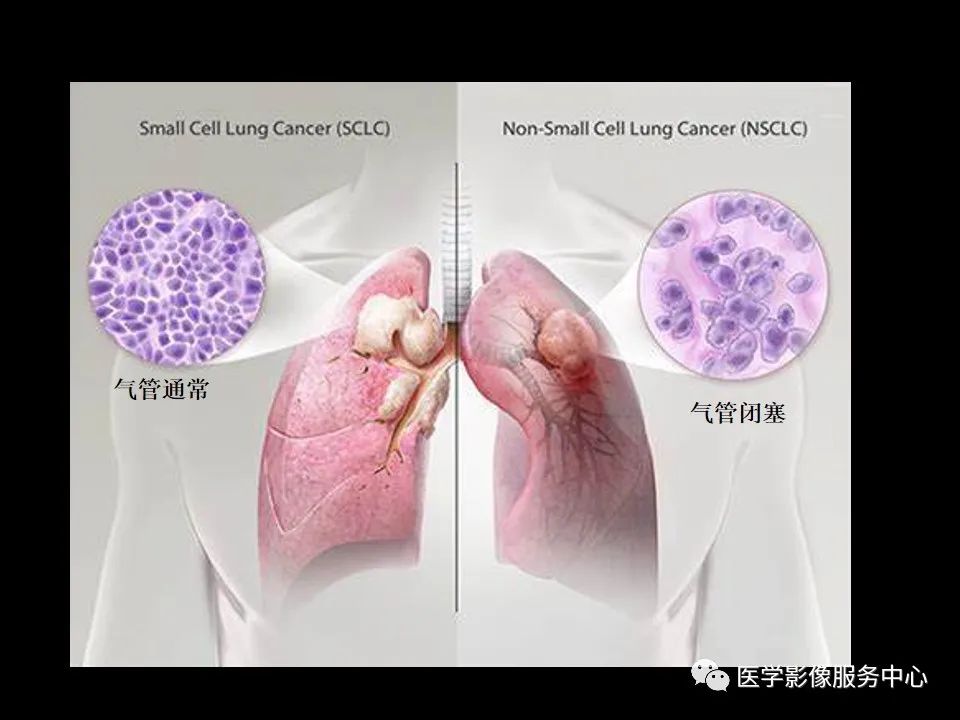 影像PPT - 【病例】中央型小细胞肺癌的CT与病理分析-16