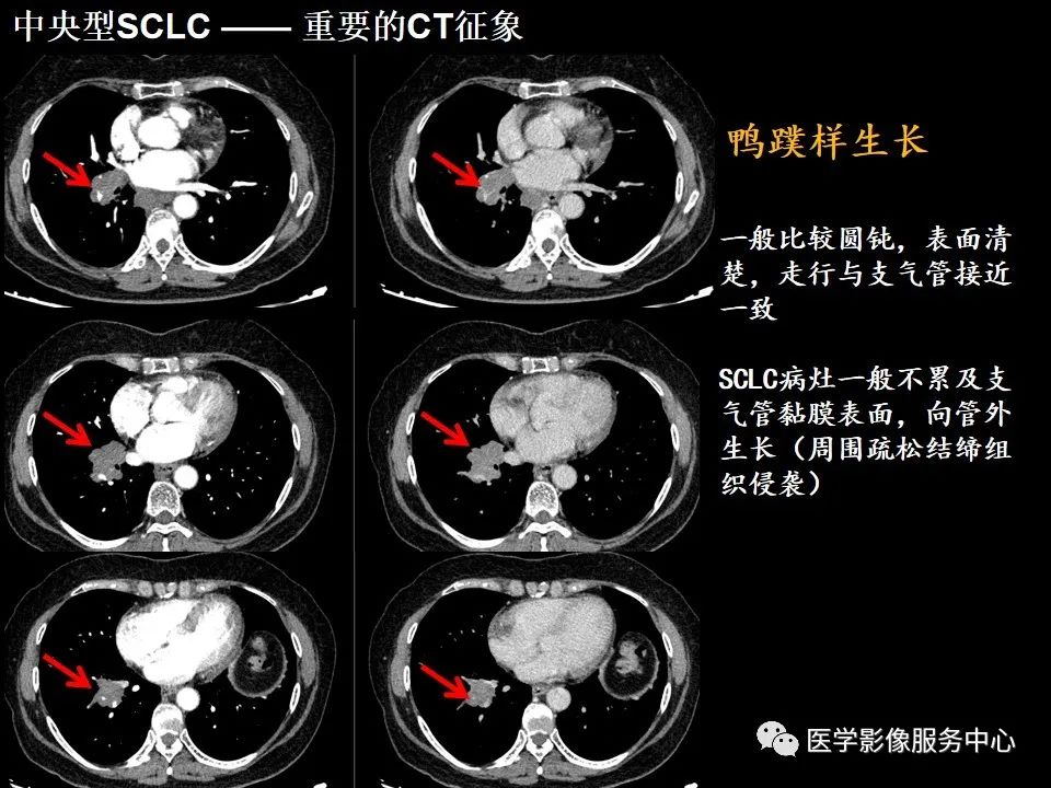影像PPT - 【病例】中央型小细胞肺癌的CT与病理分析-17