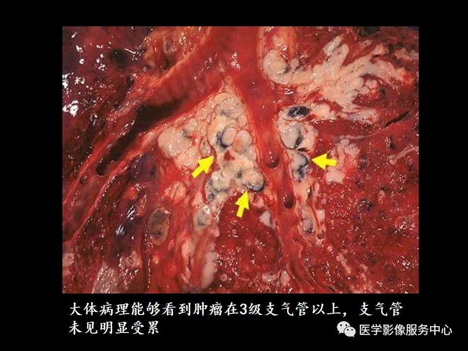影像PPT - 【病例】中央型小细胞肺癌的CT与病理分析-15