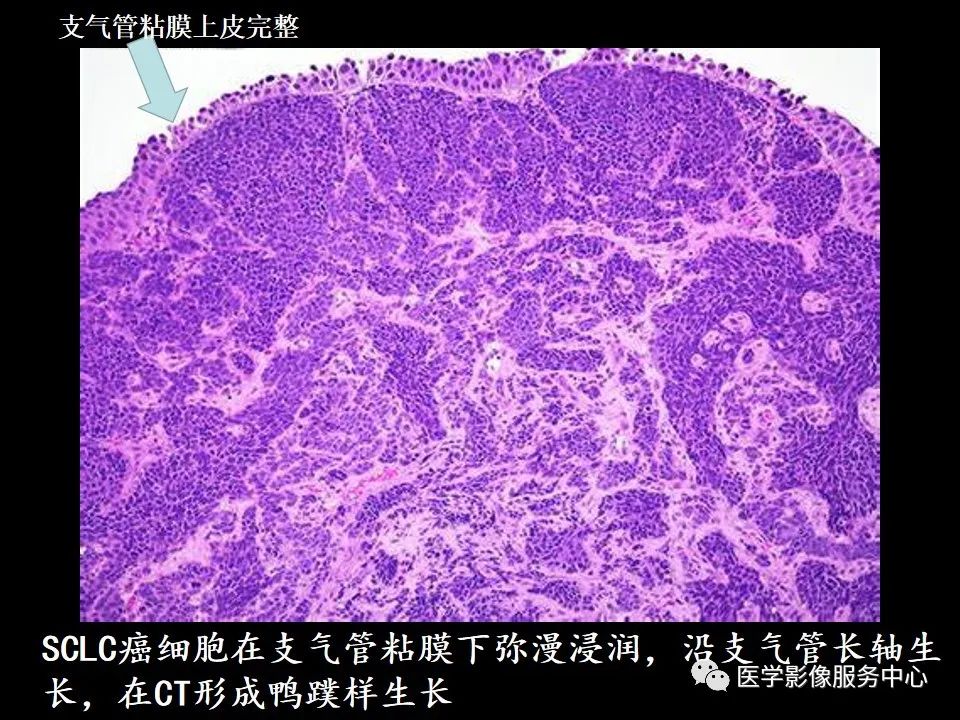 影像PPT - 【病例】中央型小细胞肺癌的CT与病理分析-18