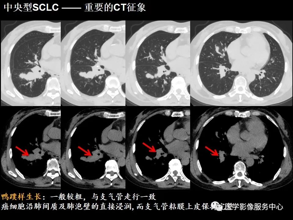 影像PPT - 【病例】中央型小细胞肺癌的CT与病理分析-19
