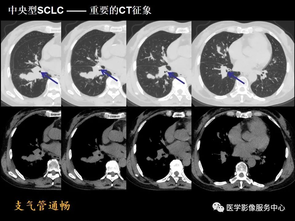 影像PPT - 【病例】中央型小细胞肺癌的CT与病理分析-21