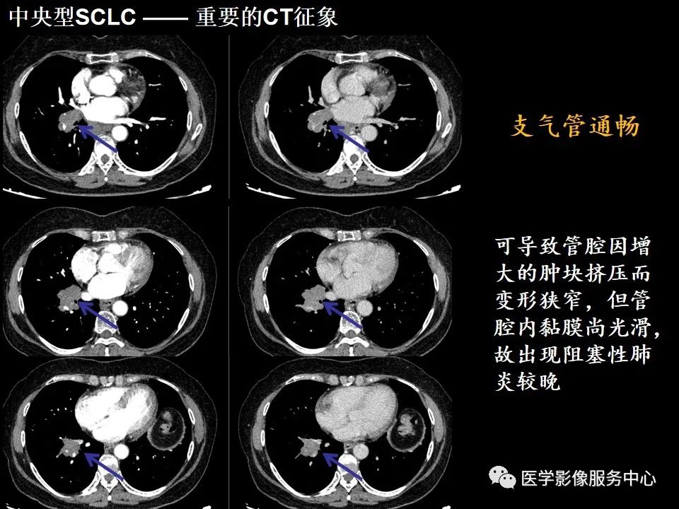 影像PPT - 【病例】中央型小细胞肺癌的CT与病理分析-20