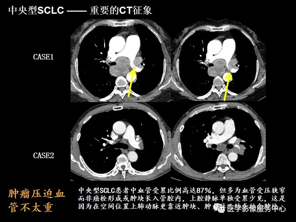 影像PPT - 【病例】中央型小细胞肺癌的CT与病理分析-22