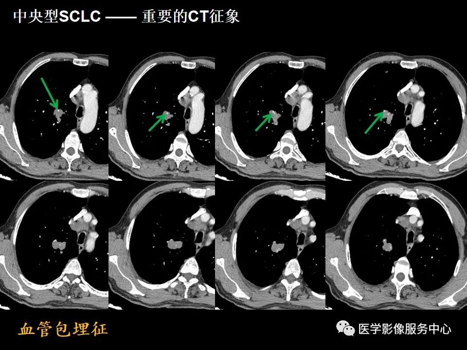 影像PPT - 【病例】中央型小细胞肺癌的CT与病理分析-23