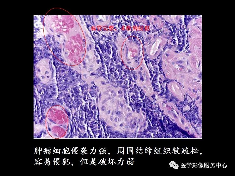 影像PPT - 【病例】中央型小细胞肺癌的CT与病理分析-24