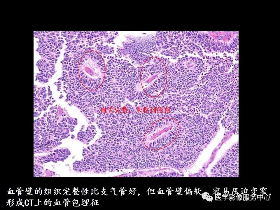 影像PPT - 【病例】中央型小细胞肺癌的CT与病理分析-25