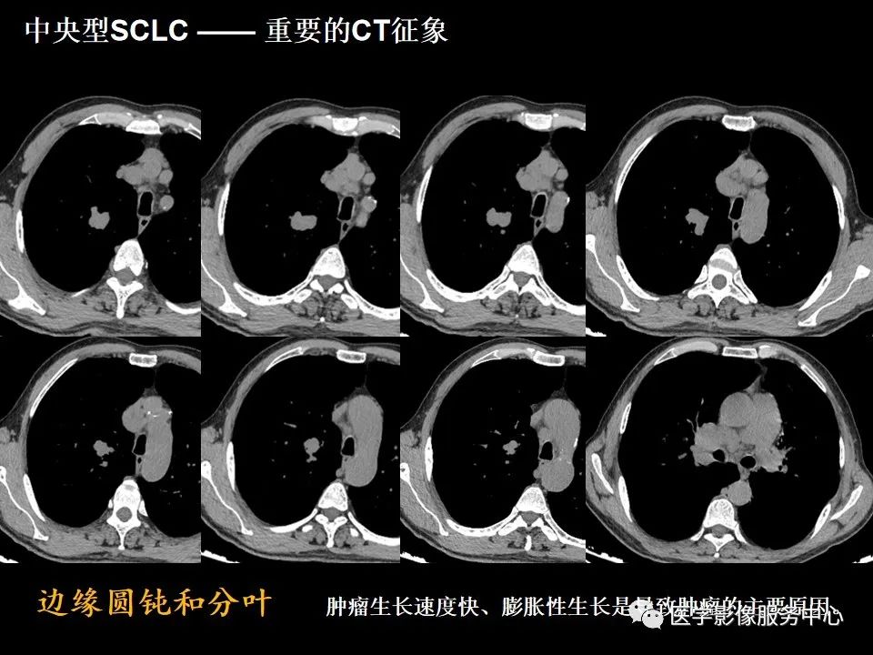 影像PPT - 【病例】中央型小细胞肺癌的CT与病理分析-26