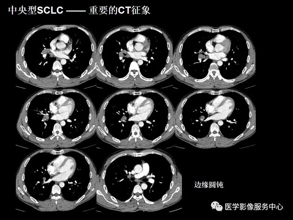 影像PPT - 【病例】中央型小细胞肺癌的CT与病理分析-27