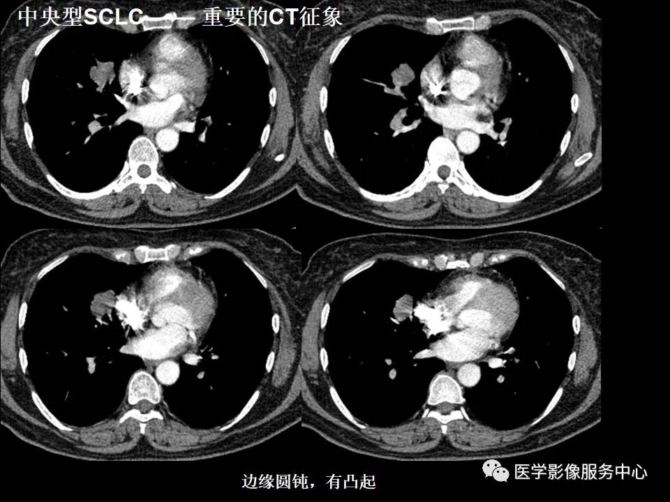 影像PPT - 【病例】中央型小细胞肺癌的CT与病理分析-28