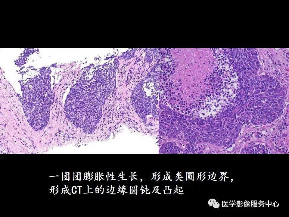 影像PPT - 【病例】中央型小细胞肺癌的CT与病理分析-29