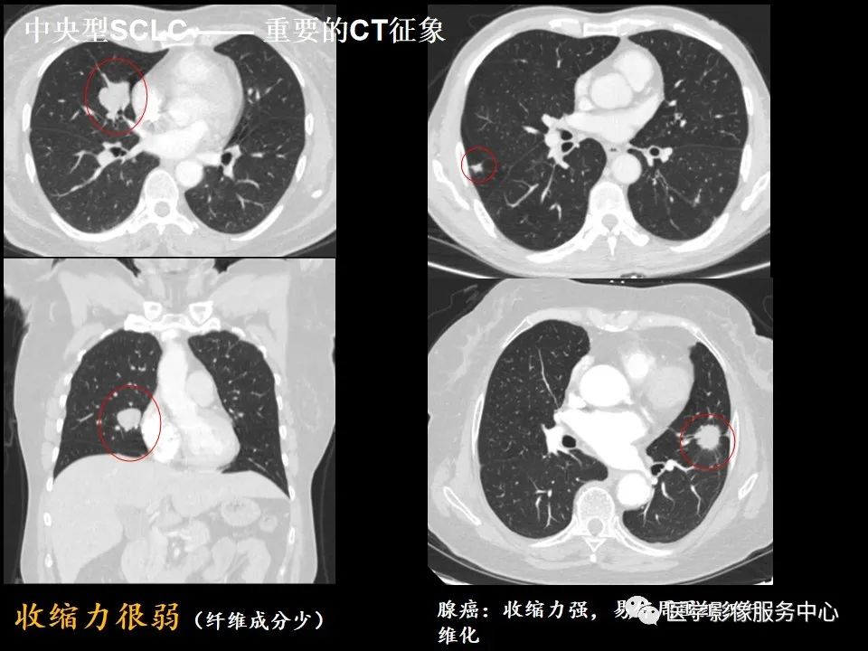 影像PPT - 【病例】中央型小细胞肺癌的CT与病理分析-30