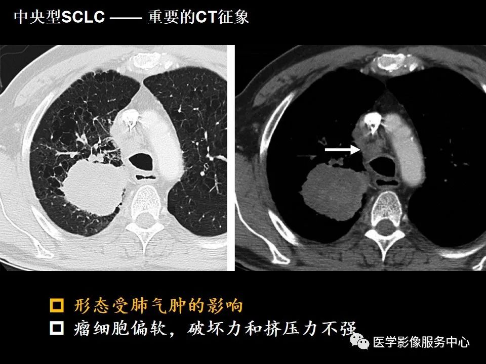 影像PPT - 【病例】中央型小细胞肺癌的CT与病理分析-31