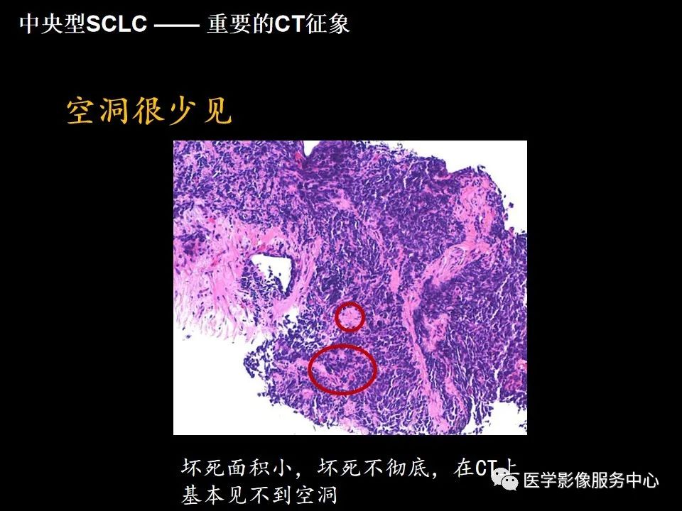影像PPT - 【病例】中央型小细胞肺癌的CT与病理分析-32