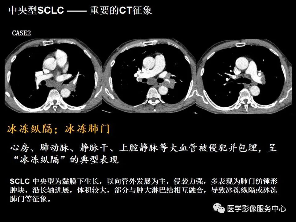 影像PPT - 【病例】中央型小细胞肺癌的CT与病理分析-33