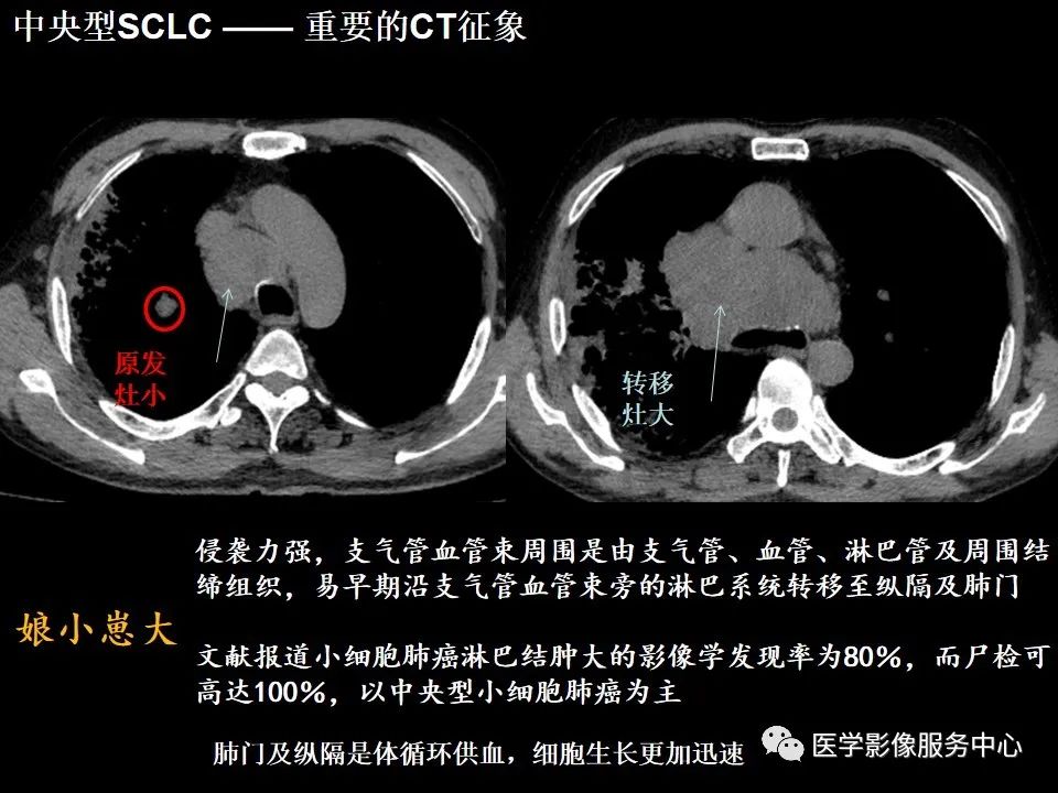 影像PPT - 【病例】中央型小细胞肺癌的CT与病理分析-35