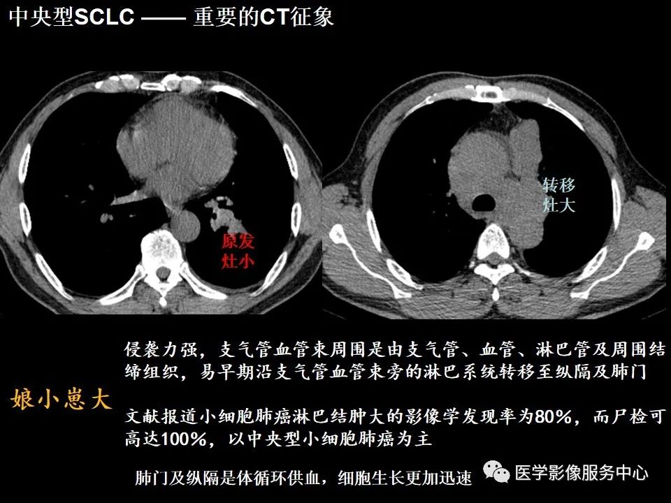 影像PPT - 【病例】中央型小细胞肺癌的CT与病理分析-36