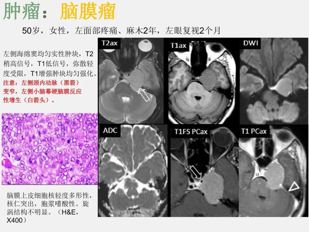 影像PPT - 【PPT】海绵窦病变的影像—病理对照-14