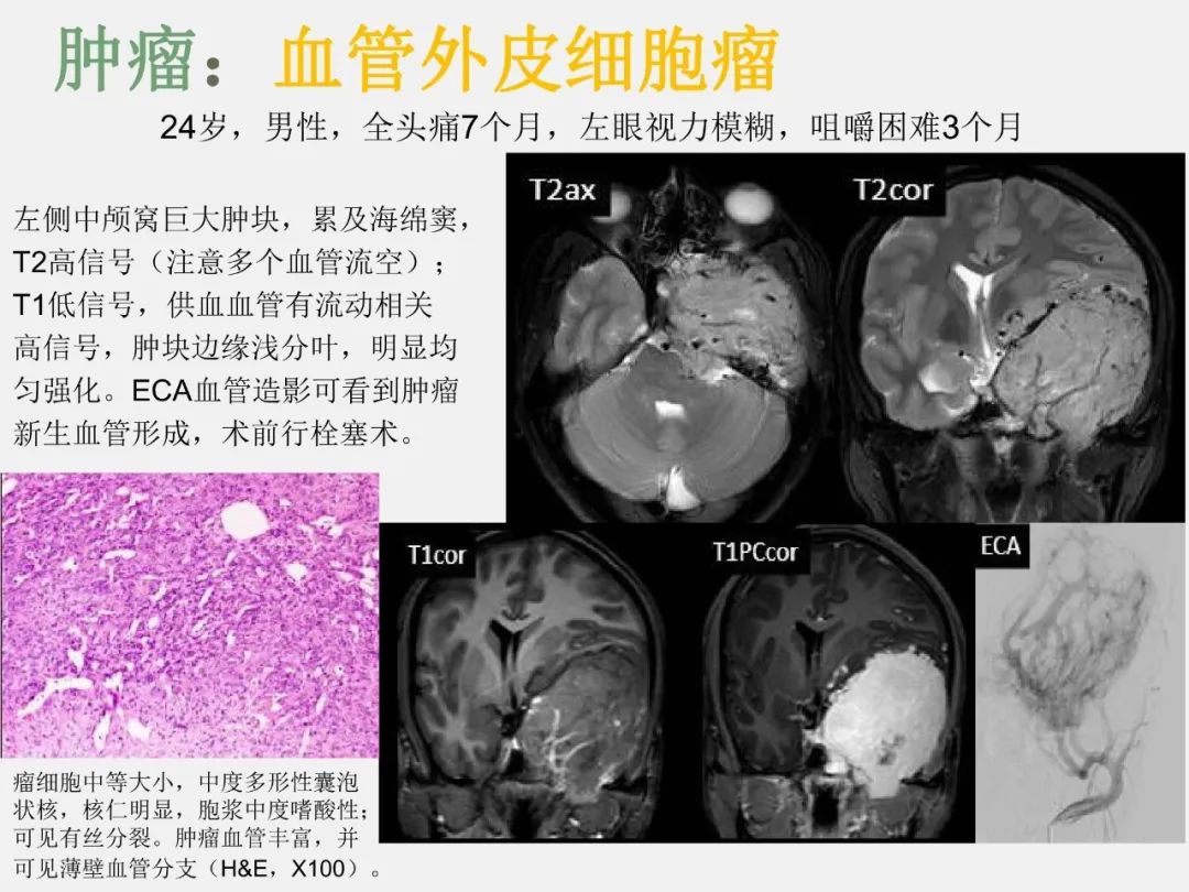影像PPT - 【PPT】海绵窦病变的影像—病理对照-16
