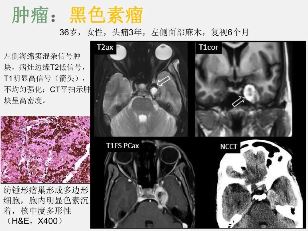 影像PPT - 【PPT】海绵窦病变的影像—病理对照-18