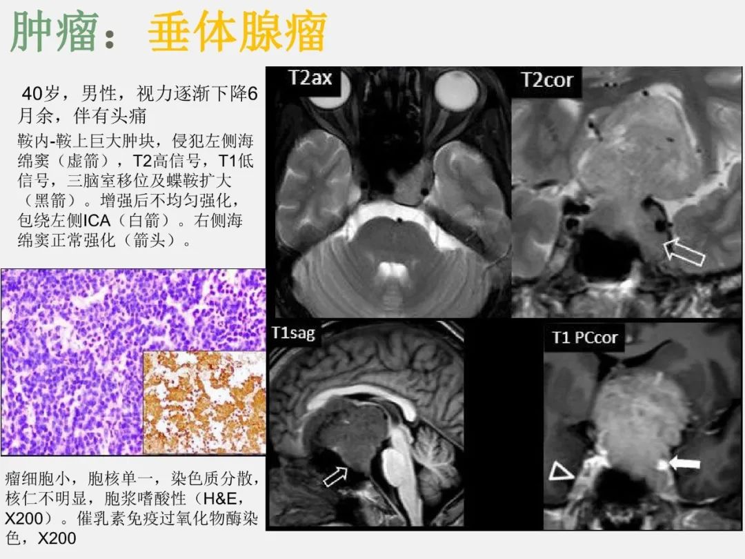 影像PPT - 【PPT】海绵窦病变的影像—病理对照-22