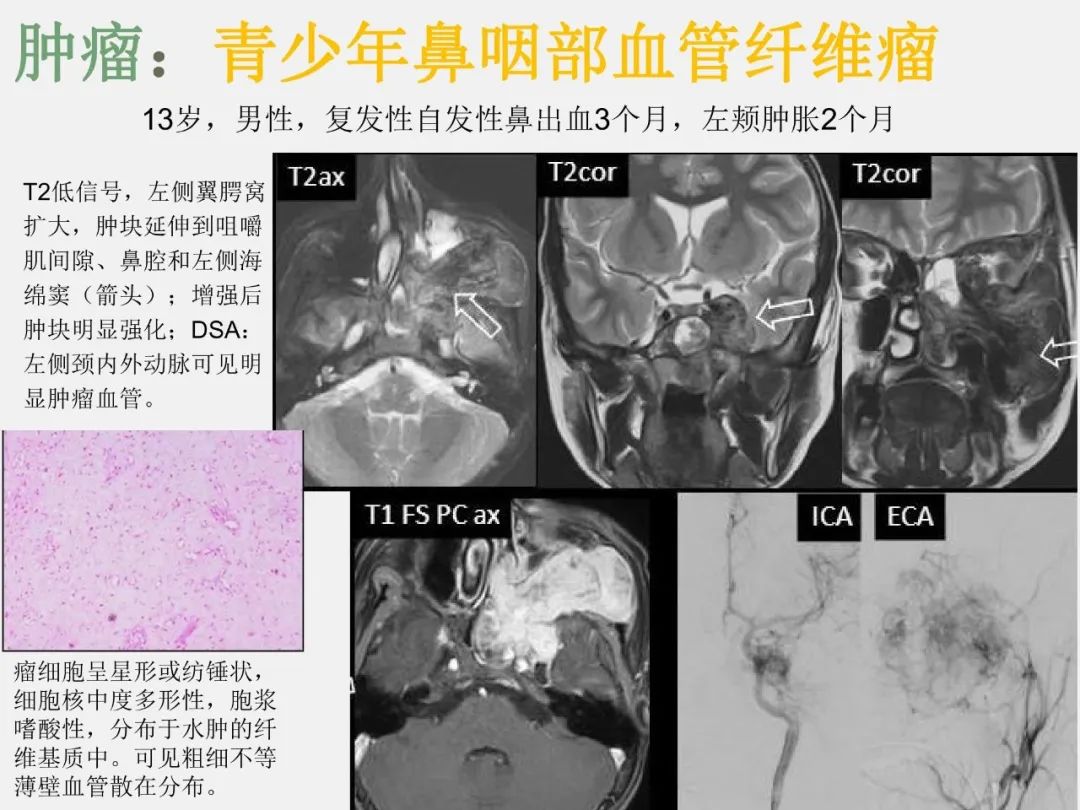 影像PPT - 【PPT】海绵窦病变的影像—病理对照-26