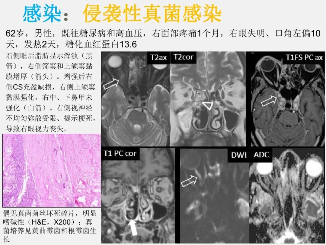 影像PPT - 【PPT】海绵窦病变的影像—病理对照-38