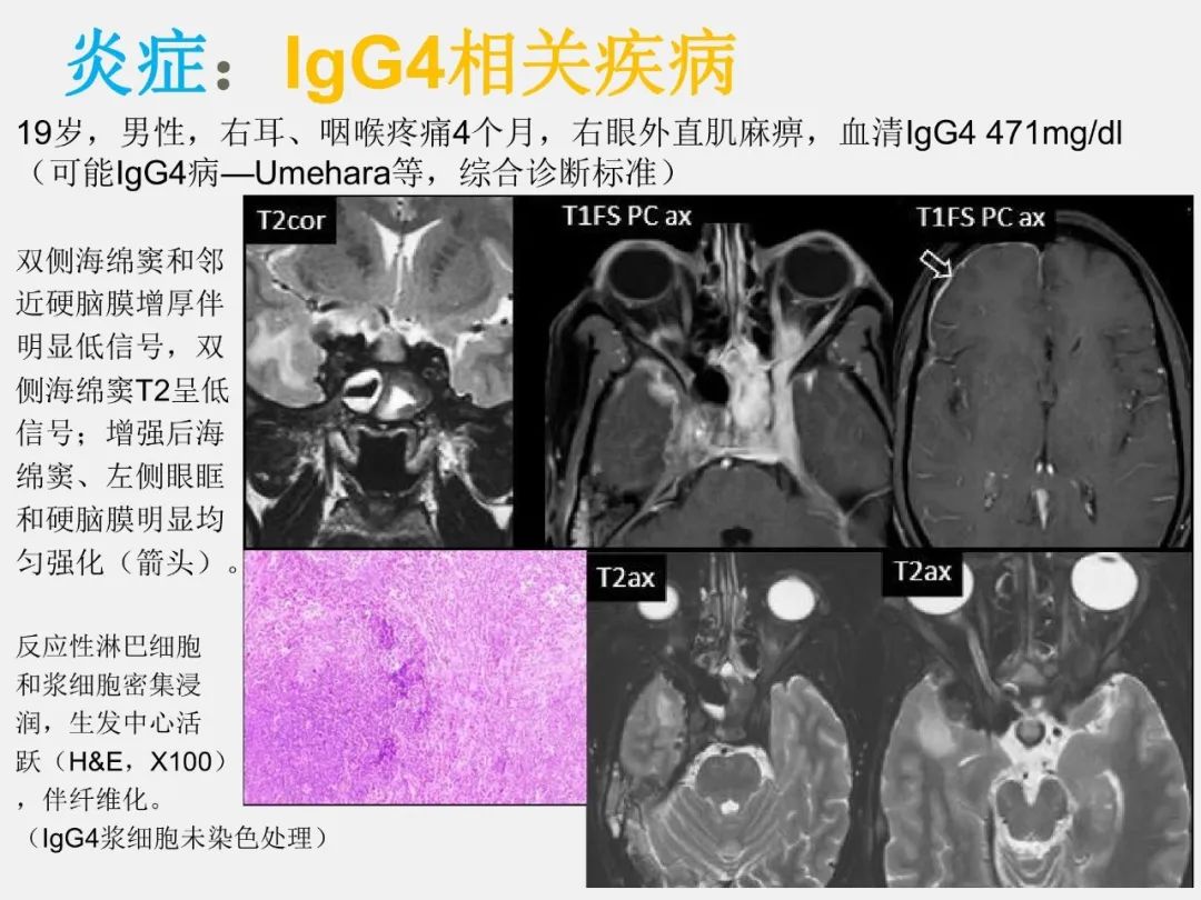 影像PPT - 【PPT】海绵窦病变的影像—病理对照-44