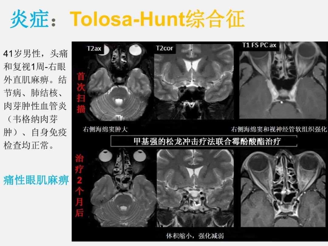 影像PPT - 【PPT】海绵窦病变的影像—病理对照-46