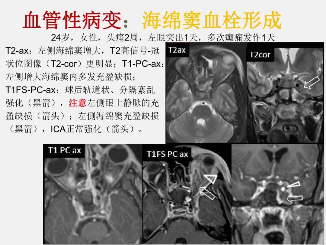 影像PPT - 【PPT】海绵窦病变的影像—病理对照-48