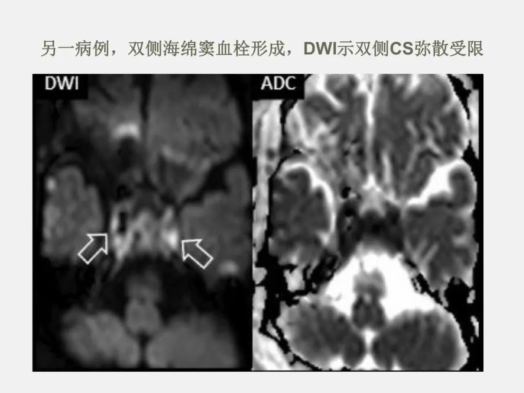 影像PPT - 【PPT】海绵窦病变的影像—病理对照-49
