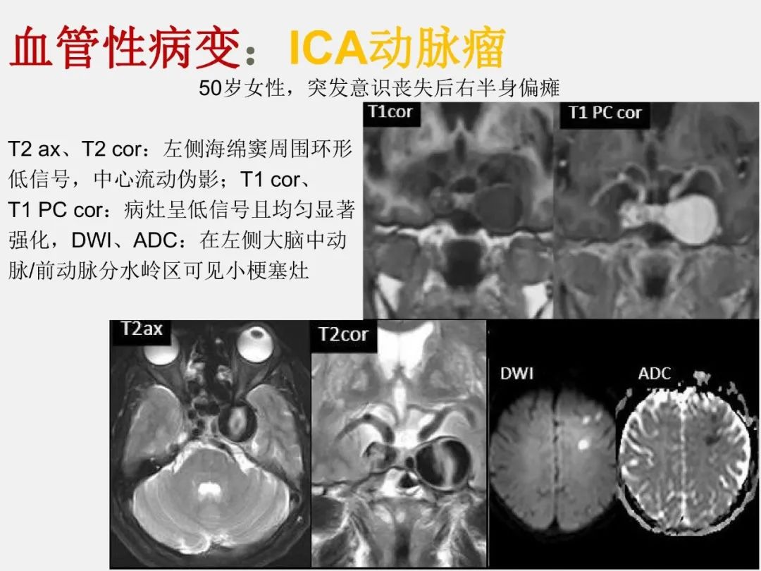 影像PPT - 【PPT】海绵窦病变的影像—病理对照-51