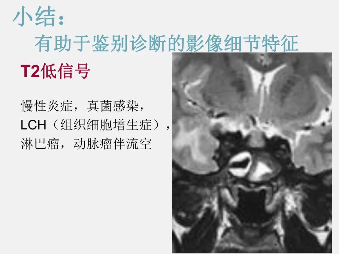 影像PPT - 【PPT】海绵窦病变的影像—病理对照-60