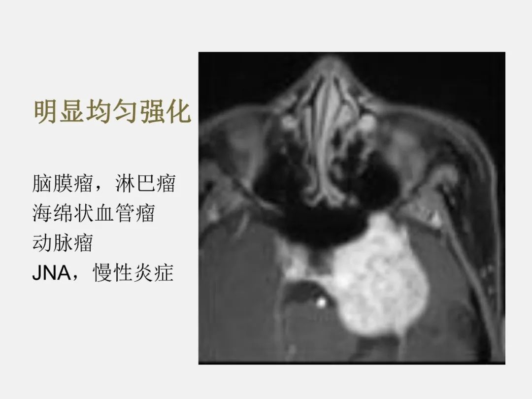 影像PPT - 【PPT】海绵窦病变的影像—病理对照-64