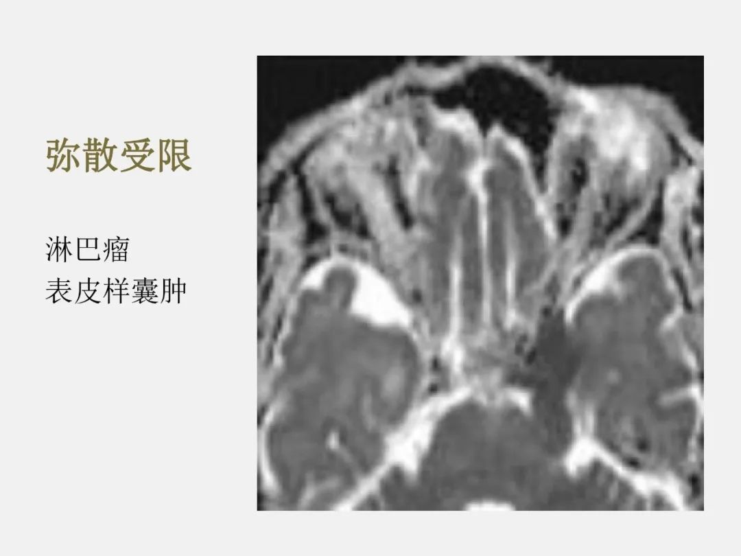 影像PPT - 【PPT】海绵窦病变的影像—病理对照-65