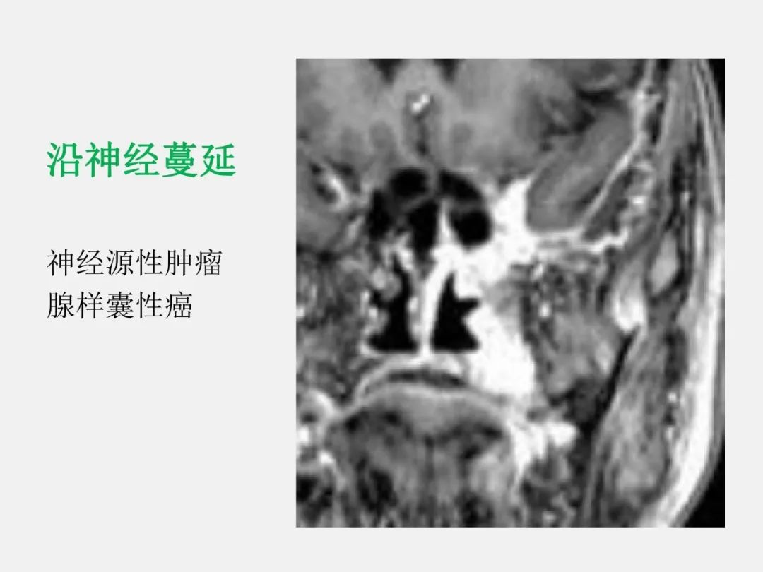 影像PPT - 【PPT】海绵窦病变的影像—病理对照-67
