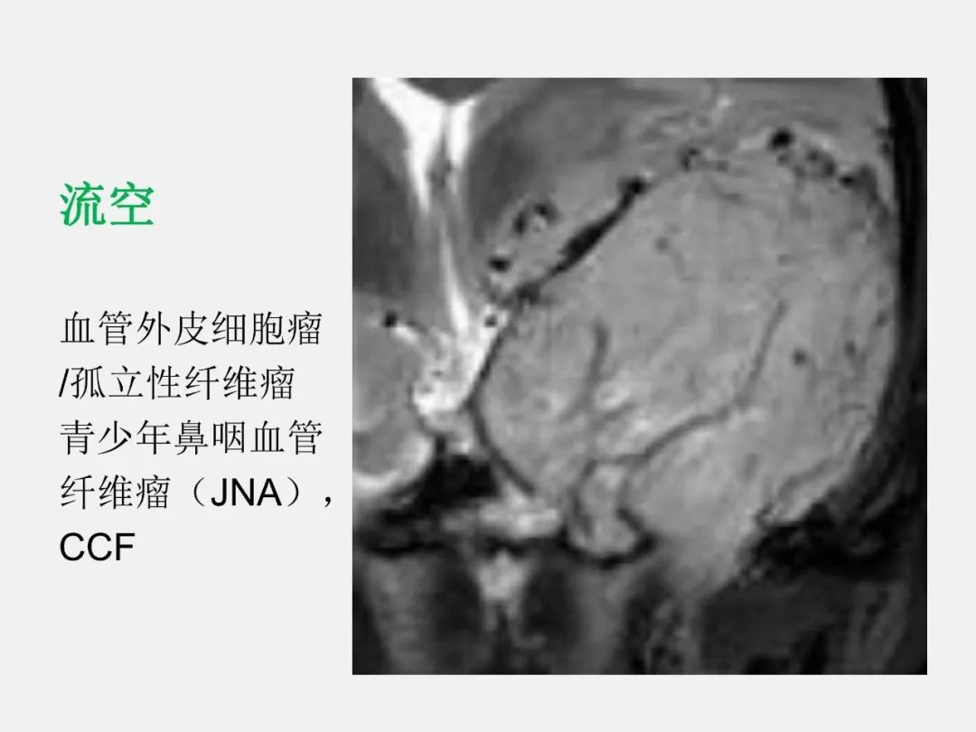 影像PPT - 【PPT】海绵窦病变的影像—病理对照-69