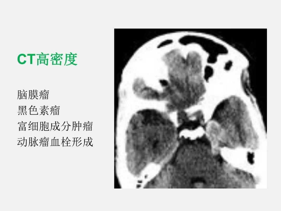 影像PPT - 【PPT】海绵窦病变的影像—病理对照-70