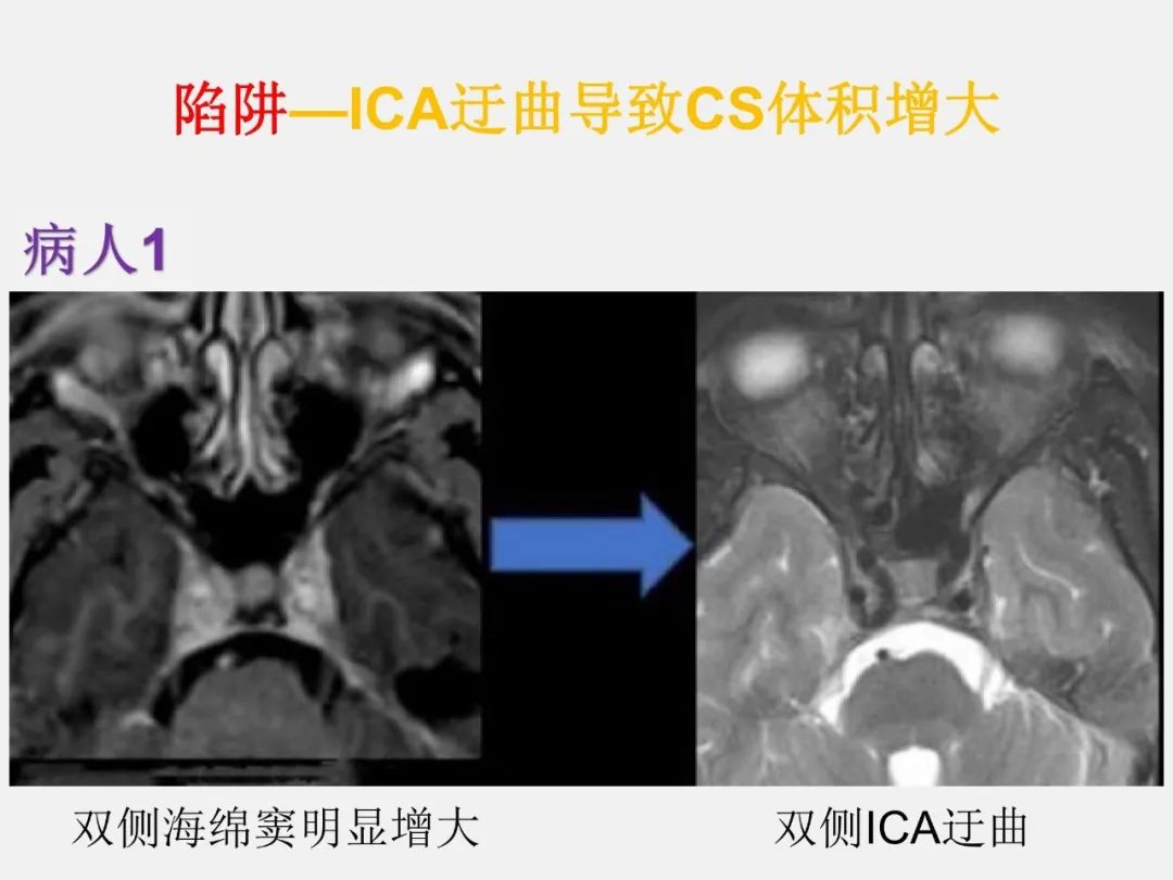 影像PPT - 【PPT】海绵窦病变的影像—病理对照-72
