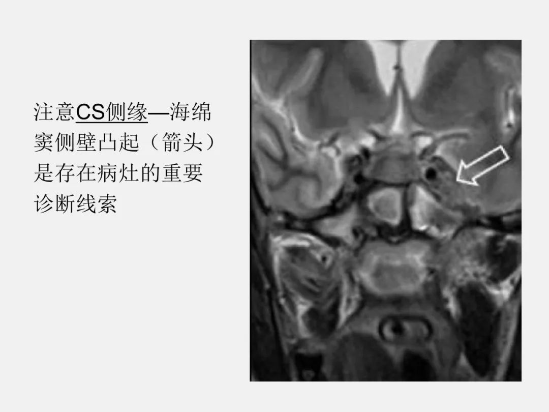 影像PPT - 【PPT】海绵窦病变的影像—病理对照-75