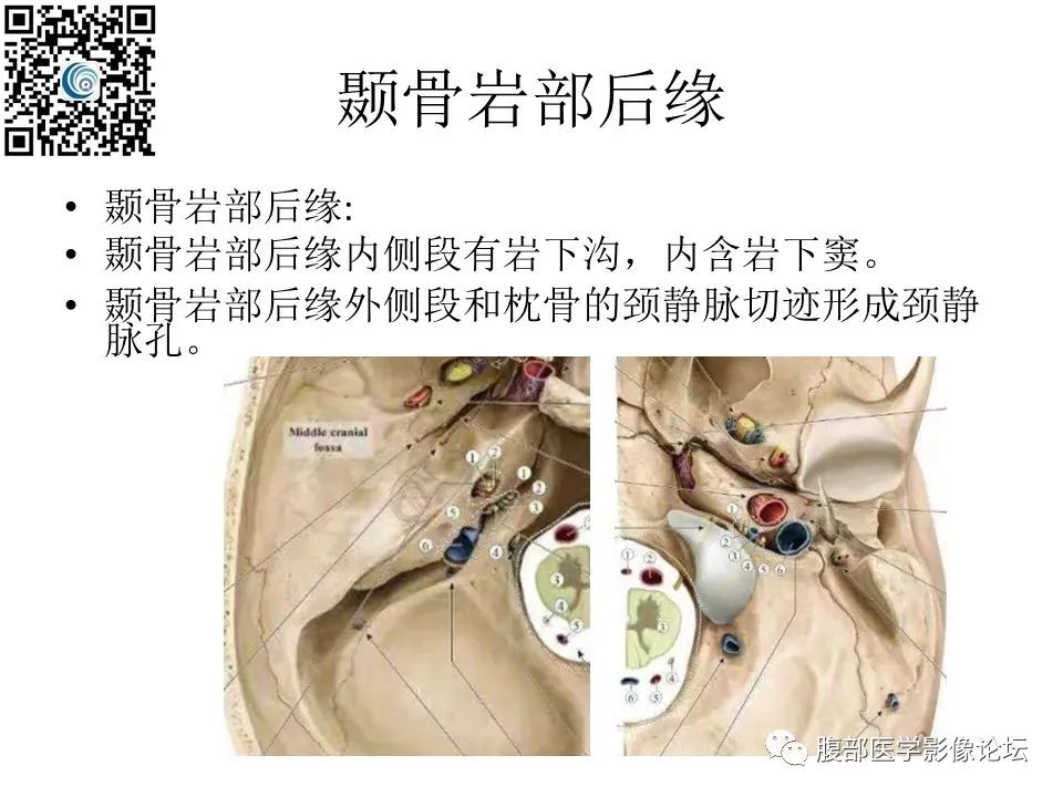 影像PPT - 【PPT】颅骨颅底系列之岩洞深处住神仙-11
