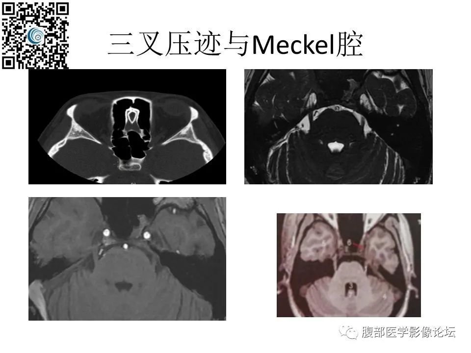 影像PPT - 【PPT】颅骨颅底系列之岩洞深处住神仙-20