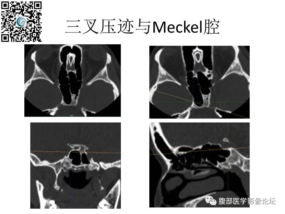 影像PPT - 【PPT】颅骨颅底系列之岩洞深处住神仙-21